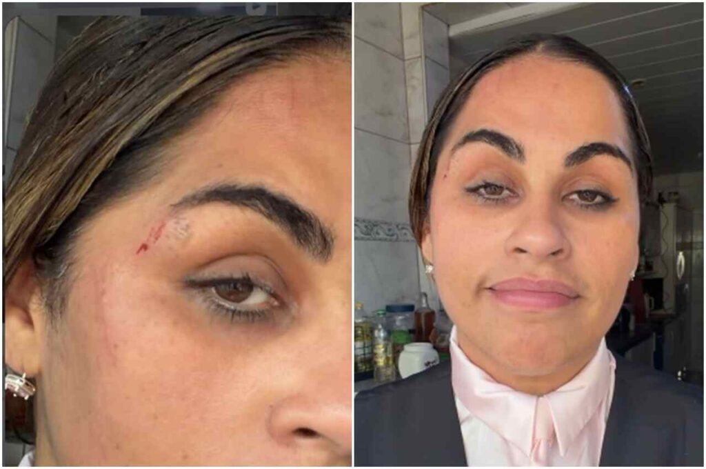 Cantora Michelle Nascimento mostra ferimento próximo à sobrancelha em foto publicada nas redes sociais.