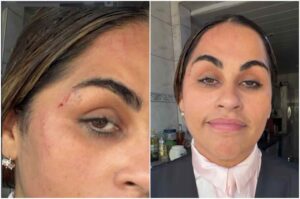 Cantora Michelle Nascimento mostra ferimento próximo à sobrancelha em foto publicada nas redes sociais.